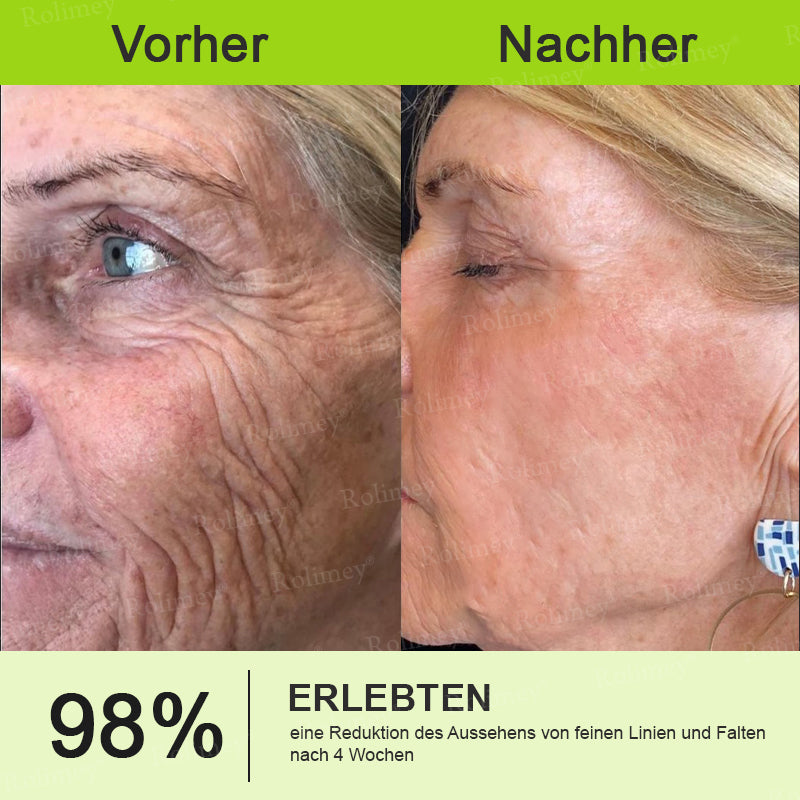 ✨✅Jetzt jugendliche Haut zurückgewinnen 💫Rolimey® Botox & Vita-A Retinol Shot Falten-Lift Straffungscreme