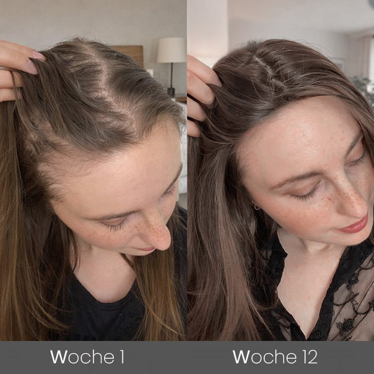 ✅🌿Offizieller Store 🇩🇪 | 🔥Rolimey® Hochwirksames Biotin & Rosmarin Haarwachstumsserum– Füllt lichte Stellen & Geheimratsecken sichtbar auf (🔥Zeitlich begrenzter Rabatt, ⏳letzte 30 Minuten)