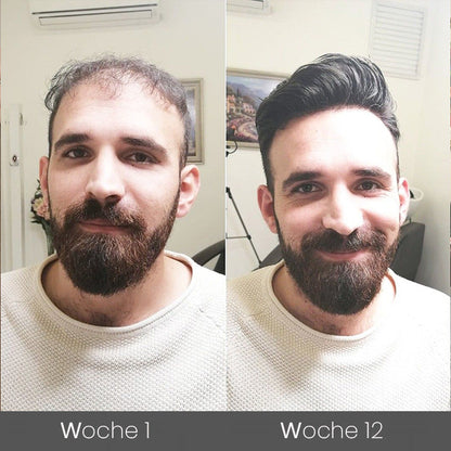 ✅🌟Offizieller Store 🇩🇪 | 🔥Rolimey® Hochwirksames Biotin & Rosmarin Haarwachstumsserum– Füllt lichte Stellen & Geheimratsecken sichtbar auf (🔥Zeitlich begrenzter Rabatt, ⏳letzte 30 Minuten)