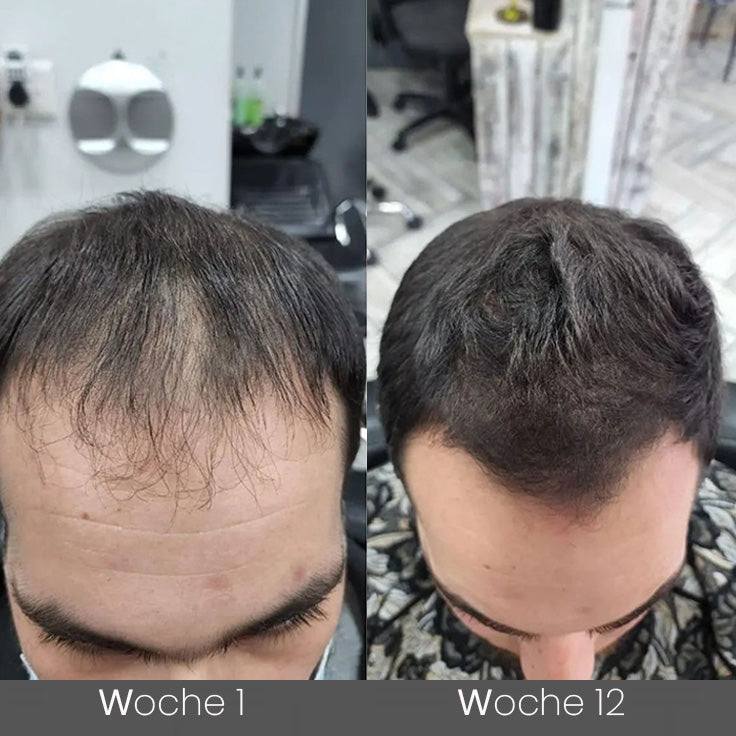 ✅🌿Offizieller Store 🇩🇪 | 🔥Rolimey® Hochwirksames Biotin & Rosmarin Haarwachstumsserum– Füllt lichte Stellen & Geheimratsecken sichtbar auf (🔥Zeitlich begrenzter Rabatt, ⏳letzte 30 Minuten)