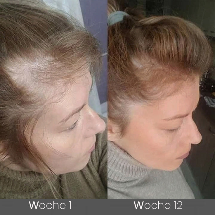 ✅🌿Offizieller Store 🇩🇪 | 🔥Rolimey® Hochwirksames Biotin & Rosmarin Haarwachstumsserum– Füllt lichte Stellen & Geheimratsecken sichtbar auf (🔥Zeitlich begrenzter Rabatt, ⏳letzte 30 Minuten)