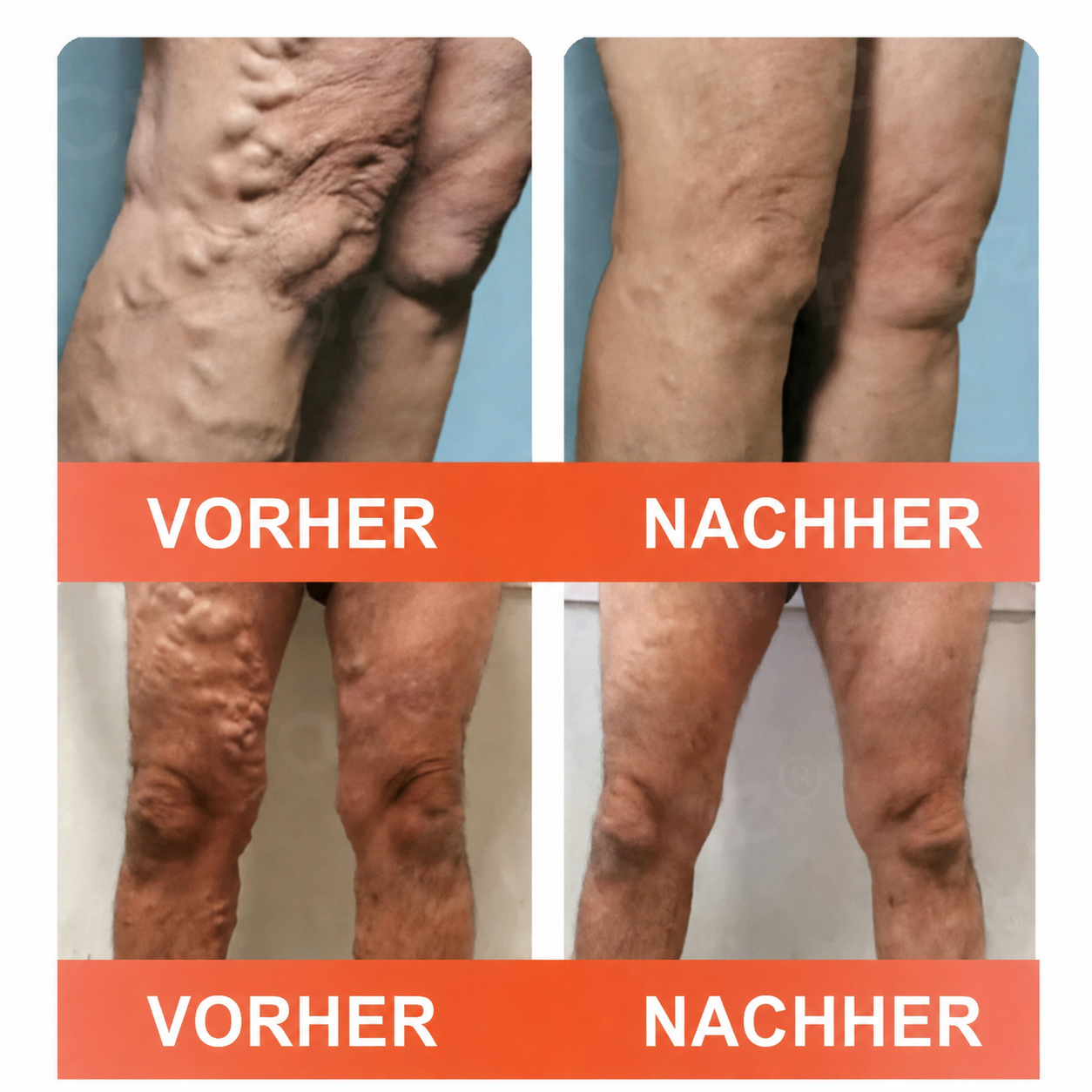 💯✨Celsiora® Vein Ease Mikronadel-Pflegepflaster (Bei Besenreisern, Krampfadern, Schwellungen & müden Beinen) 🔥 Letzter Aktionstag – 50% Rabatt