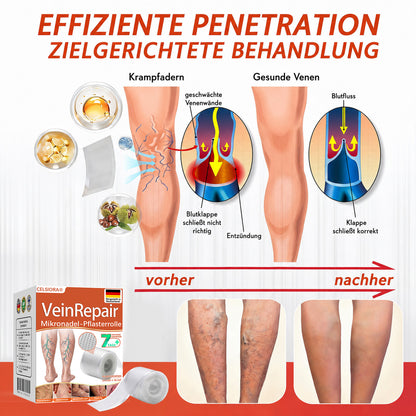 💯✨Celsiora® Vein Ease Mikronadel-Pflegepflaster (Bei Besenreisern, Krampfadern, Schwellungen & müden Beinen) 🔥 Letzter Aktionstag – 50% Rabatt