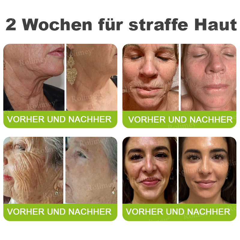 ✨✅Jetzt jugendliche Haut zurückgewinnen 💫Rolimey® Botox & Vita-A Retinol Shot Falten-Lift Straffungscreme